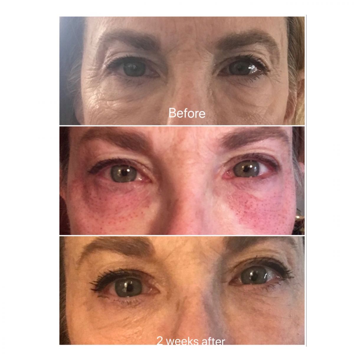 plasma-skin-tightening-before-and-after